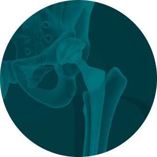 imagem thumb artroplastia