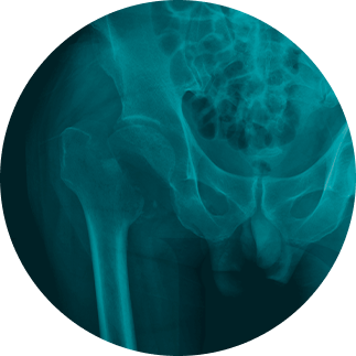 imagem-thumb-fratura-no-quadril