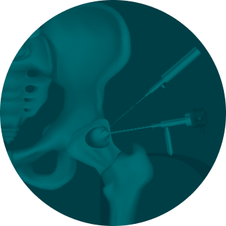 imagem thumb videoartroscopia